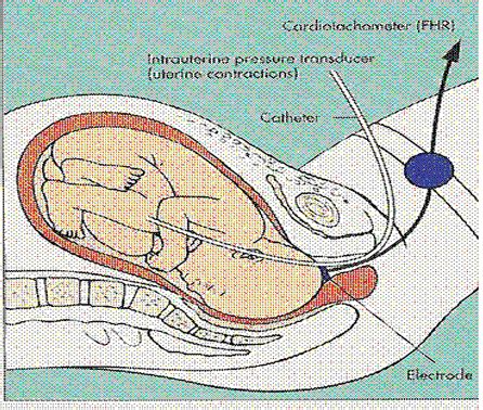 Mbbs, BDS, B-Pharma Direct Admission call 7050599189: Methods of Assessing Fetal Status