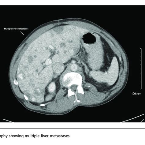 Computed Tomography of the Abdomen | Download Scientific Diagram