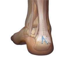 Achilles Insertional Debridement (Spur Removal) & Repair | Stirling | Nedlands