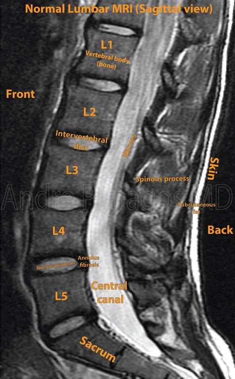 Lumbar Mri In Case A Sagittal Mri Shows L Intervertebral Disc | My XXX Hot Girl