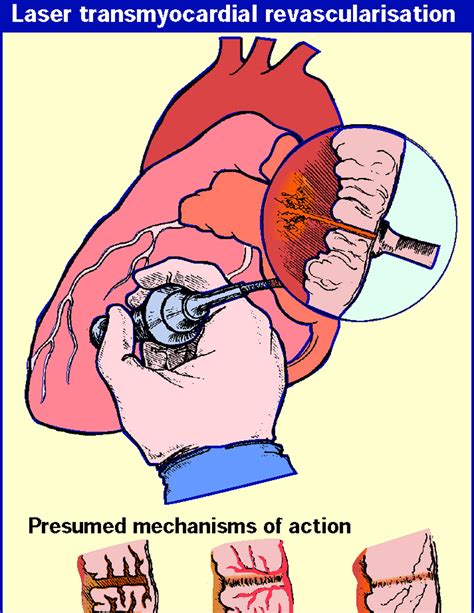 Heart Surgery: Types, Survival Rate & Cost