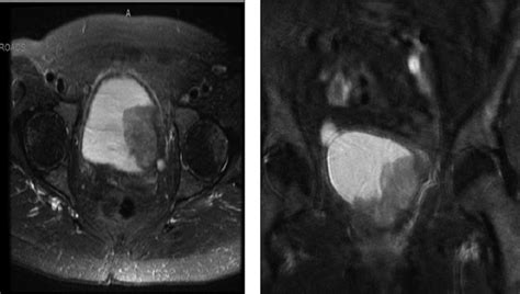 T2 weighted contrast enhanced MRI in axial and coronal views ...