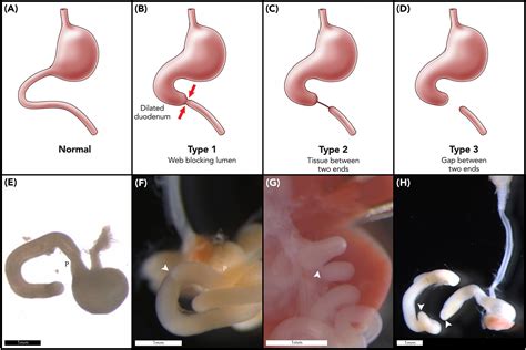 Frontiers | The Role of Fibroblast Growth Factor 10 Signaling in Duodenal Atresia