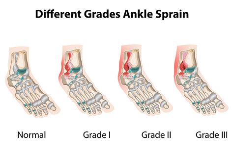 Lateral Ankle Ligament Sprains: Symptoms & Treatment – Injury Health Blog