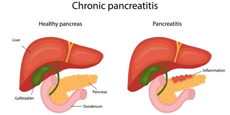 Pancreatitis and Alcohol: How Drinking Harms Vital Organs - The Woods At Parkside