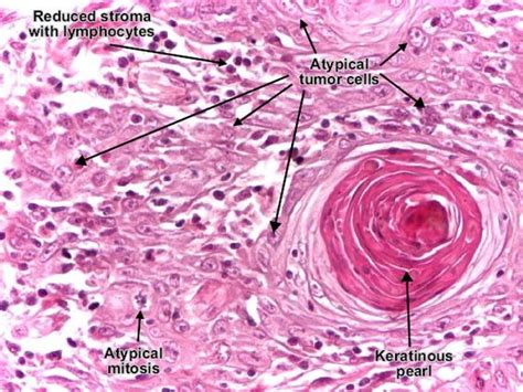 squamous cell carcinoma histology - Google Search | PATHOLOGY ...