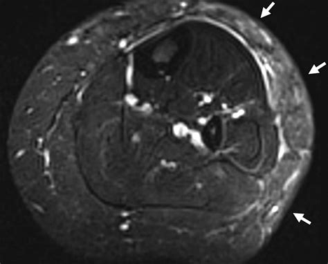 MR Imaging of Soft-Tissue Vascular Malformations: Diagnosis, Classification, and Therapy Follow ...