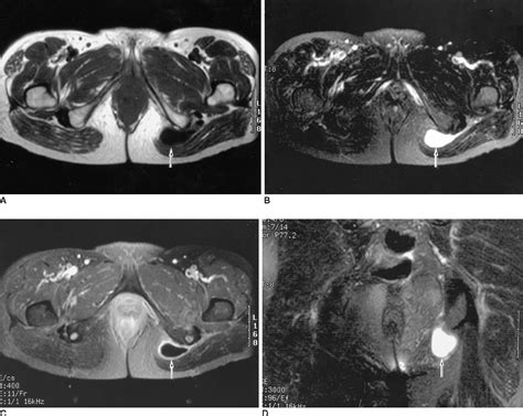 Figure 1 from Non-Infectious Ischiogluteal Bursitis: MRI Findings ...