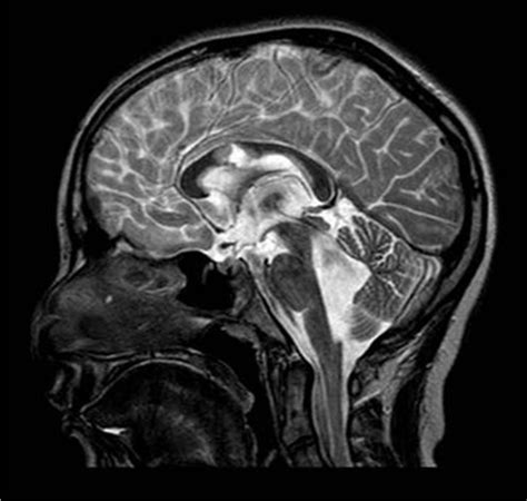 Sagittal T2 MRI scan showing “inverted” flow at the mesencephalic... | Download Scientific Diagram