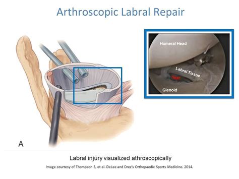 Shoulder Labral Tear- Labral Repair and Rehabilitation: Ashvin K. Dewan, MD: Orthopedic Surgeon