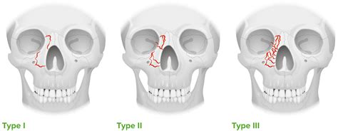 Fracturas Orbitales | Concise Medical Knowledge