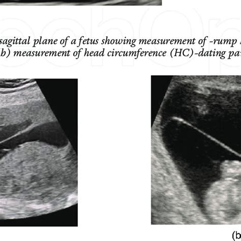 (PDF) Prenatal Screening: A Tool to Predict, Prevent, and Prepare