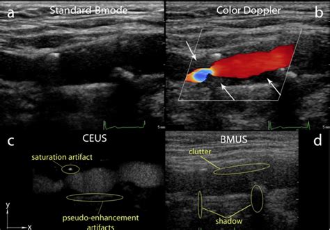 An example of a carotid artery image acquired with different ultrasound... | Download Scientific ...