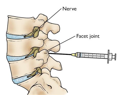 facet-joint-injections | AllSpine