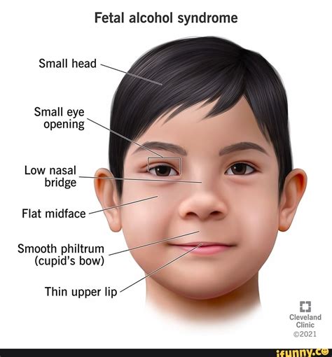 Fetal alcohol syndrome Small head Small eye opening Low nasal bridge Flat midface Smooth ...