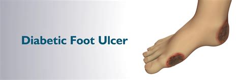 Causes Foot Ulcer Wound - vrogue.co