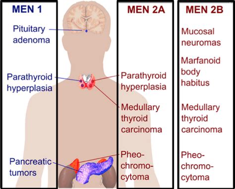 Sippleov syndróm - Syndróm mnohopočetnej endokrinnej neoplazmy MEN-2A ...