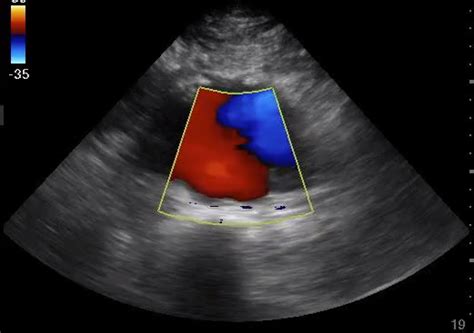 US - Abdominal Aortic Aneurysm - Ultrasound Case of the Month — Taming ...