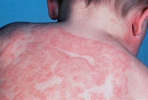 What causes Eczema? – What causes this?