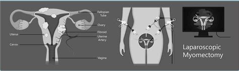 Types of Myomectomy: Hysteroscopic, Laparoscopic, Abdominal