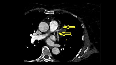 Anomalous Origin of the Right Coronary Artery From the Mid-Portion of ...