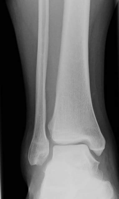 High Ankle Sprain & Syndesmosis Injury - Foot & Ankle - Orthobullets