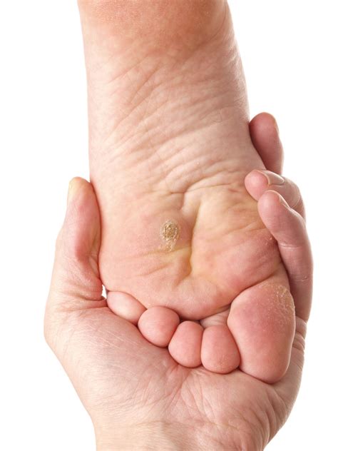 Plantar Warts Treatment - Experienced Perth Foot Surgeon