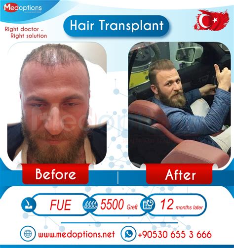 Hair Transplant Istanbul in Turkey before after photos from customers