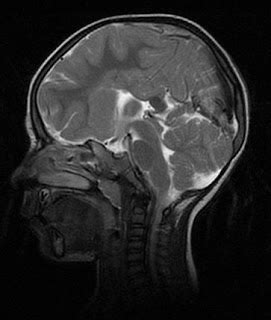 Holoprosencephaly - MRI - Sumer's Radiology Blog