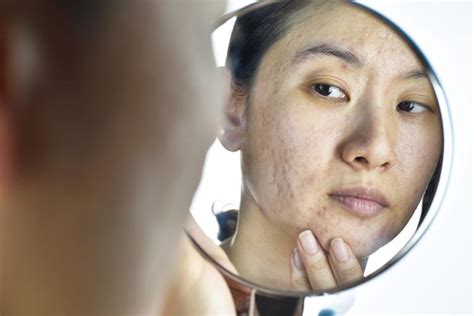 How psychodermatology treats skin conditions from the inside out ...