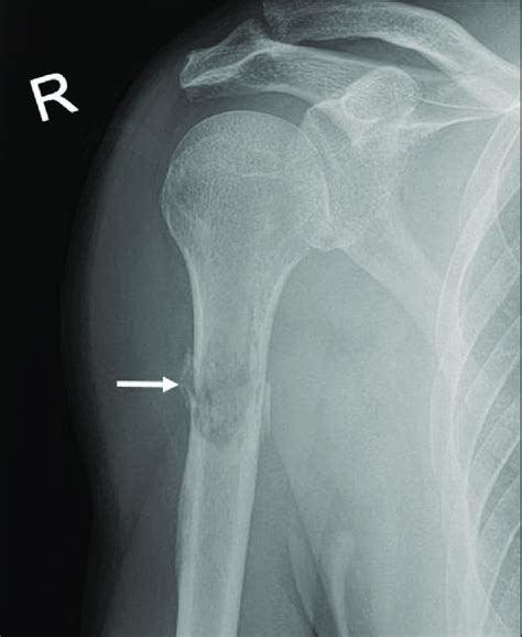 Humerus X Ray