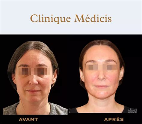 PRX-T33 light peel Paris Dr Abbou and Dr Pessis Plastic Surgeons