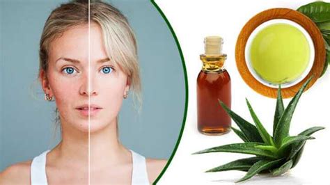 Acne Rosacea Natural Treatment and Diet The Natural Cure