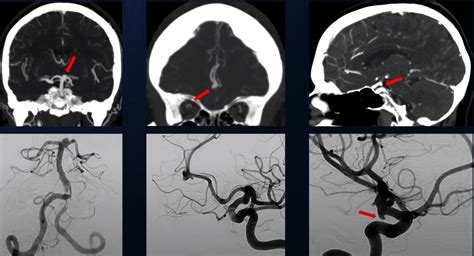 Brain Aneurysm | Barrow Neurological Institute