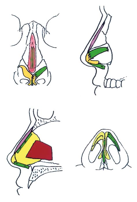 Nasal Valve Reconstruction: Experience in 53 Consecutive Patients | JAMA Facial Plastic Surgery ...