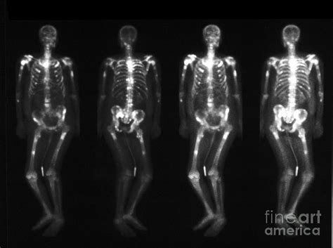 Bone Scan Showing Multiple Metastases #4 Photograph by Scott Camazine - Fine Art America