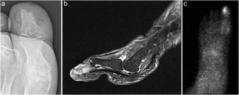 Distal Syme Hallux Amputation for Tip of Toe Wounds and Gangrene ...