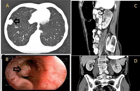 Cureus | Isolated Renal Metastasis from Primary Lung Squamous Cell ...