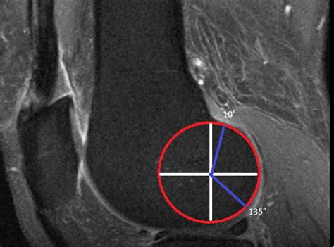 The Lateral Femoral Condyle is not Hypoplastic Relative to the Medial Condyle in 6829 Magnetic ...