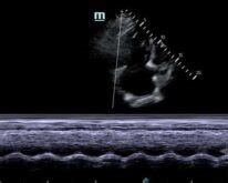 Tapse Echocardiography Normal & Abnormal Value, Measurement