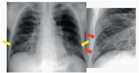 Pulmonary Edema (Interstitial) | Radiology Key