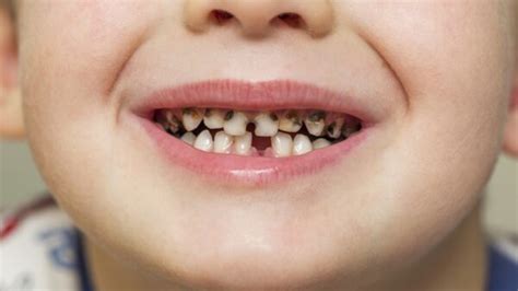 What Causes Children’s Cavities and How to Avoid Them - Scottsdale ...