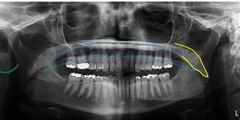 infraorbital canal – Dr. G's Toothpix