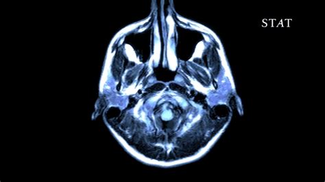 77 Mri Brain Ideas Mri Brain Radiology Imaging Radiol - vrogue.co