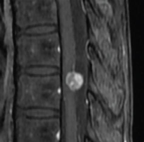 MRI findings showing an intradural-extramedullary mass with... | Download Scientific Diagram