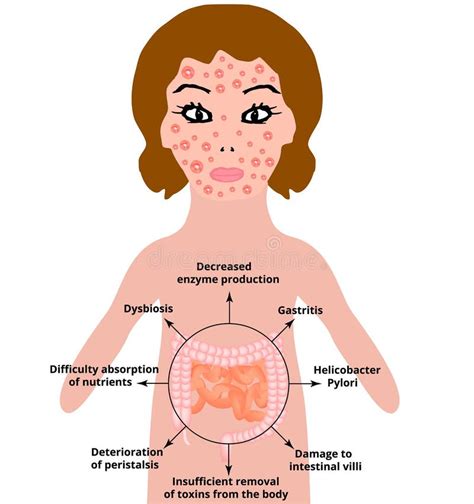 The Anatomical Structure of the Intestine. Bowel Diseases Affect the ...