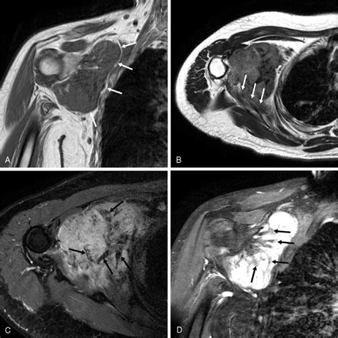 Desmoid tumor MRI - wikidoc