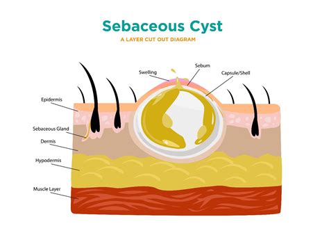 10 Symptoms and Treatments of Sebaceous Cysts - Facty Health