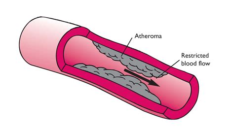 Coronary thrombosis causes, symptoms & treatment - Healthpulls