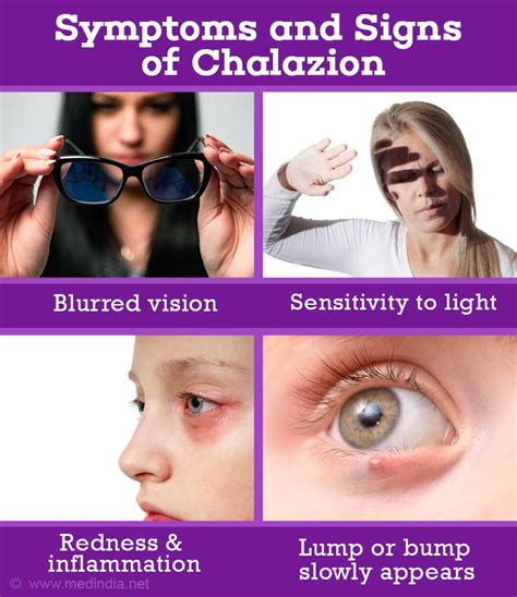 Chalazion (Eyelid Condition) - Causes, Symptoms, Signs, Diagnosis, Treatment, Prevention